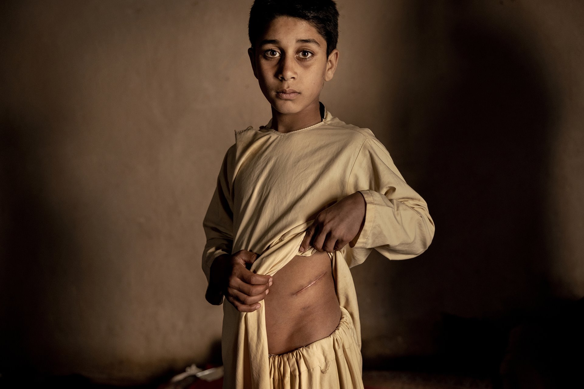 World Press Photo Contest 2023. Global Winner. Storia dell'anno. Khalil Ahmad (15) mostra la cicatrice dell'asportazione del rene ©EMads Nissen